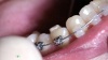 Невидимые брекеты позволяют делать зубы ровными и красивыми в любом возрасте