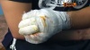 Спасавшему замерзающих на оренбургской трассе полицейскому ампутировали пальцы