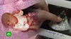 В Нижнем Тагиле ребенка выписали из больницы с обломком катетера в вене